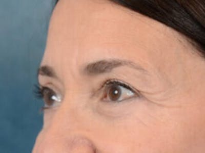 Eyelid Lift Before & After Gallery - Patient 5923298 - Image 4
