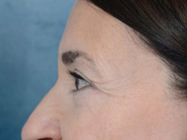 Eyelid Lift Before & After Gallery - Patient 5923298 - Image 6