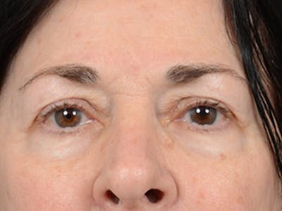 Upper Eyelid Lift Before