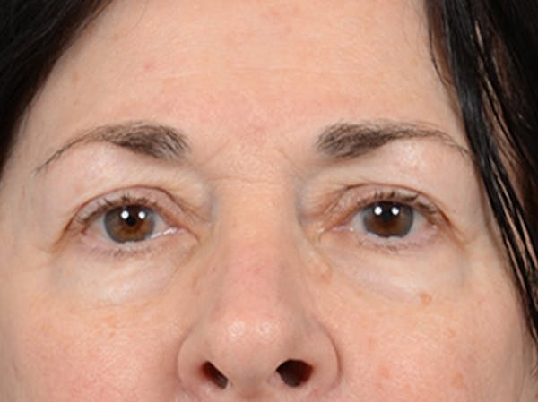Eyelid Lift Before & After Gallery - Patient 6158495 - Image 1