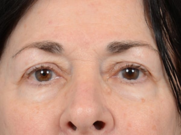 Eyelid Lift Gallery - Patient 6158495 - Image 1