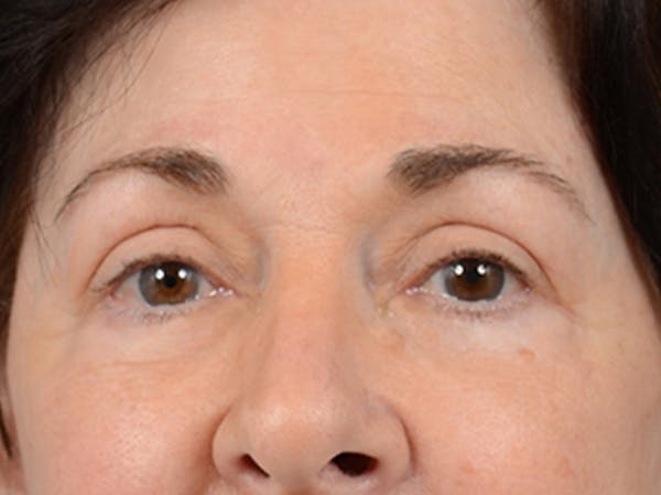 Eyelid Lift Before & After Gallery - Patient 6158495 - Image 2