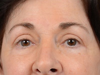 Upper Eyelid Lift After