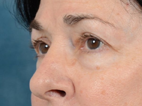 Eyelid Lift Before & After Gallery - Patient 6158495 - Image 3