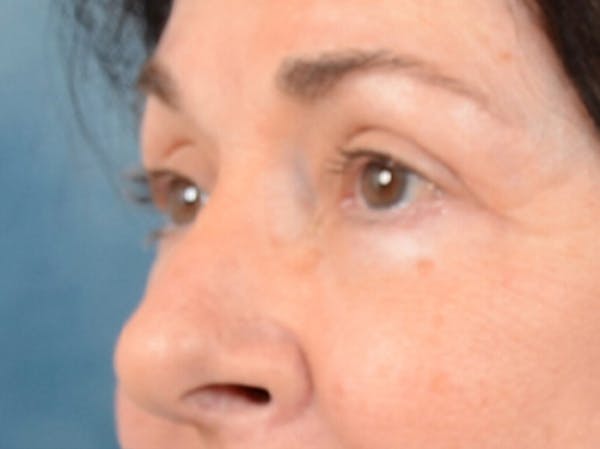 Eyelid Lift Gallery - Patient 6158495 - Image 4