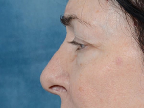 Eyelid Lift Gallery - Patient 6158495 - Image 5
