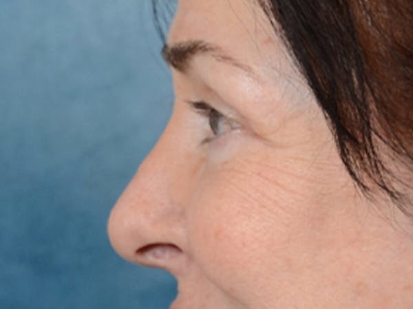 Eyelid Lift Before & After Gallery - Patient 6158495 - Image 6