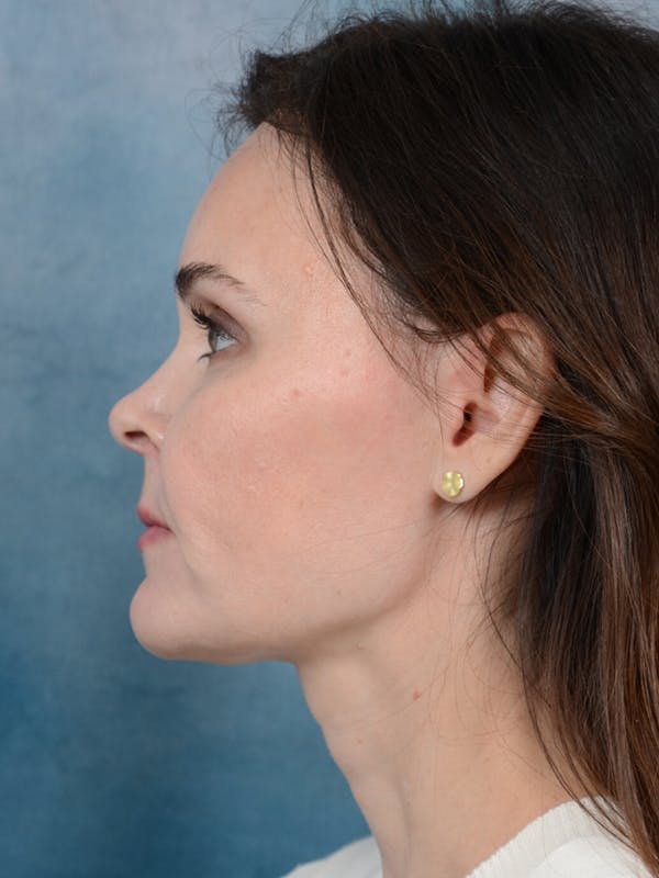 Deep Plane Facelift Before & After Gallery - Patient 26207310 - Image 6