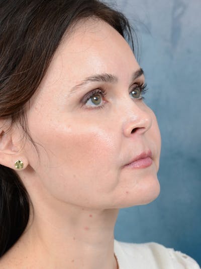 Deep Plane Facelift Before & After Gallery - Patient 26207310 - Image 8