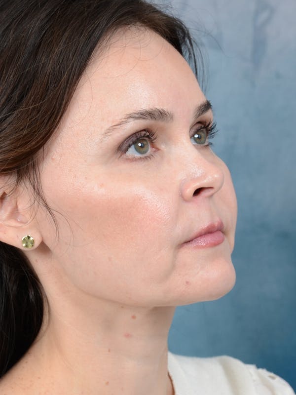 Deep Plane Facelift Before & After Gallery - Patient 26207310 - Image 8