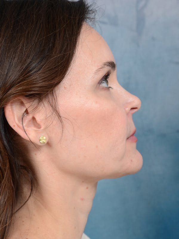 Deep Plane Facelift Before & After Gallery - Patient 26207310 - Image 10