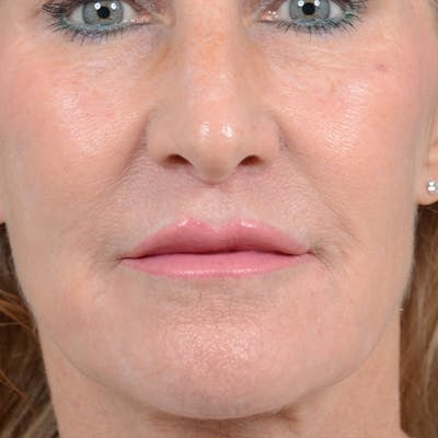 Lip Lift Before & After Gallery - Patient 16861941 - Image 2