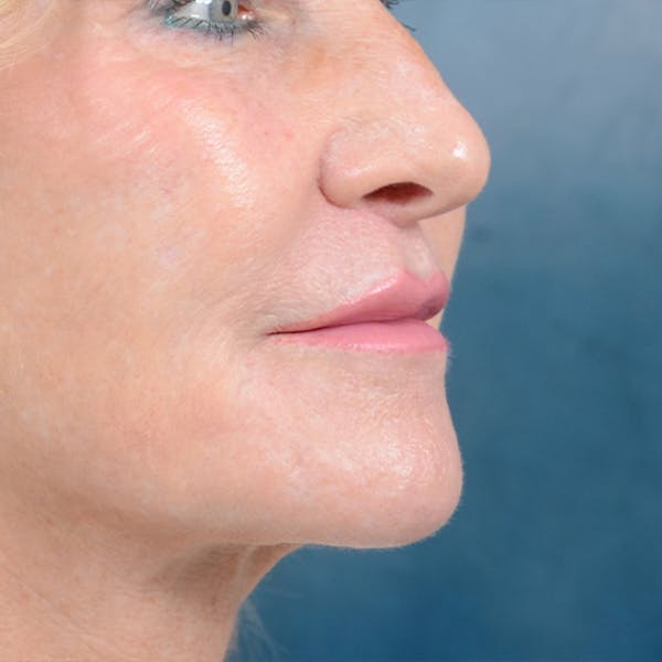 Lip Lift Before & After Gallery - Patient 16861941 - Image 4