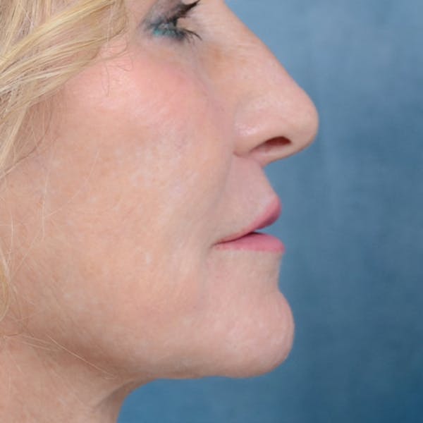Lip Lift Before & After Gallery - Patient 16861941 - Image 6