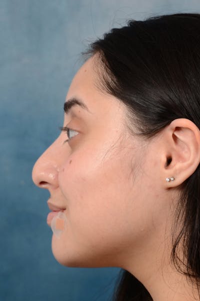 Rhinoplasty Before & After Gallery - Patient 29394117 - Image 1