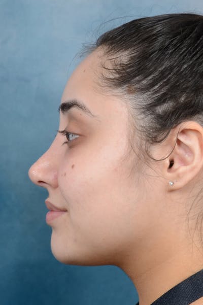 Rhinoplasty Before & After Gallery - Patient 29394117 - Image 2