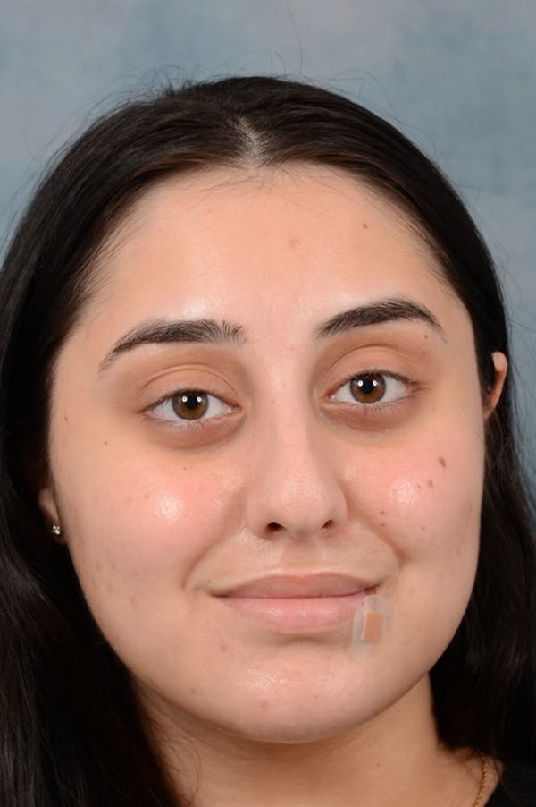 Rhinoplasty Before & After Gallery - Patient 29394117 - Image 3