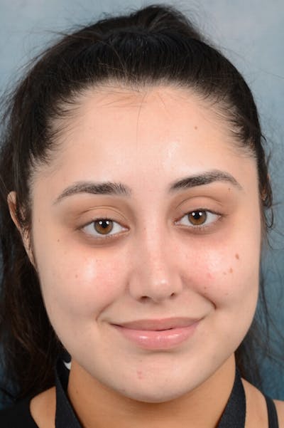 Rhinoplasty Before & After Gallery - Patient 29394117 - Image 4