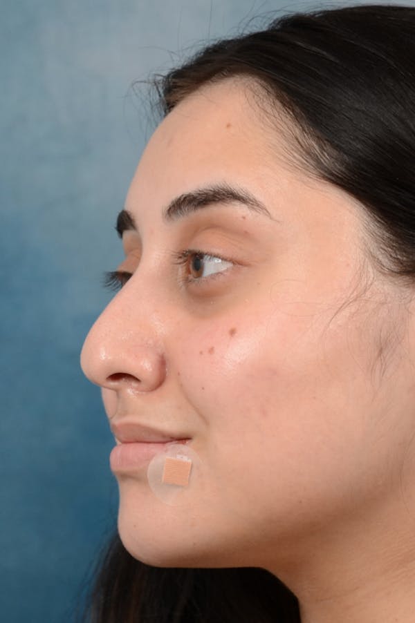 Rhinoplasty Before & After Gallery - Patient 29394117 - Image 5