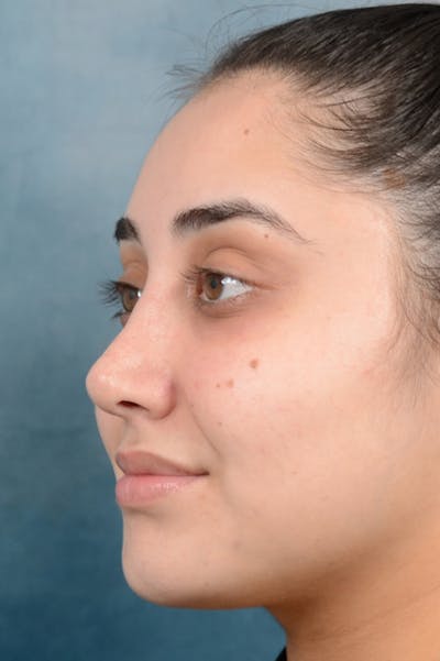 Rhinoplasty Before & After Gallery - Patient 29394117 - Image 6