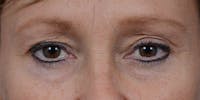 Eyelid Lift Before & After Gallery - Patient 29409181 - Image 1