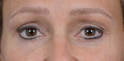 Eyelid Lift Before & After Gallery - Patient 29409181 - Image 2