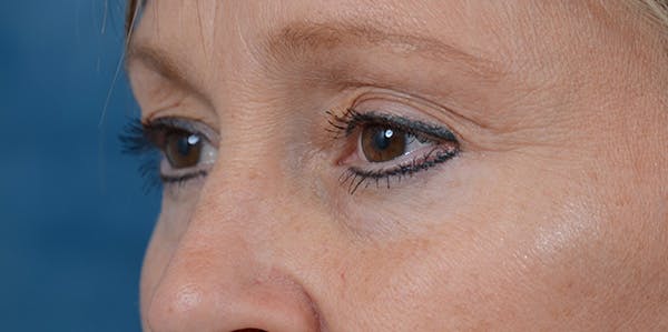 Eyelid Lift Before & After Gallery - Patient 29409181 - Image 3