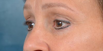 Eyelid Lift Before & After Gallery - Patient 29409181 - Image 4