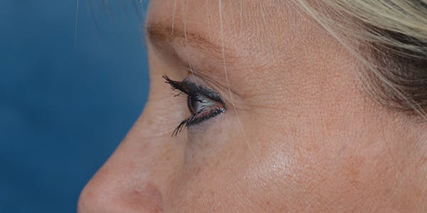 Eyelid Lift Before & After Gallery - Patient 29409181 - Image 5