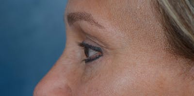 Eyelid Lift Before & After Gallery - Patient 29409181 - Image 6