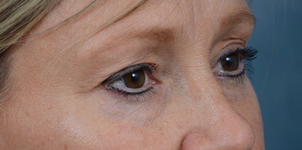 Eyelid Lift Before & After Gallery - Patient 29409181 - Image 7