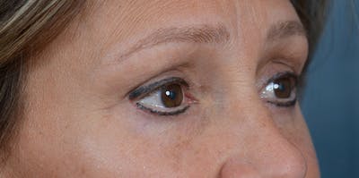 Eyelid Lift Before & After Gallery - Patient 29409181 - Image 8