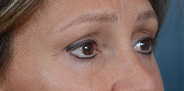 Eyelid Lift Before & After Gallery - Patient 29409181 - Image 8