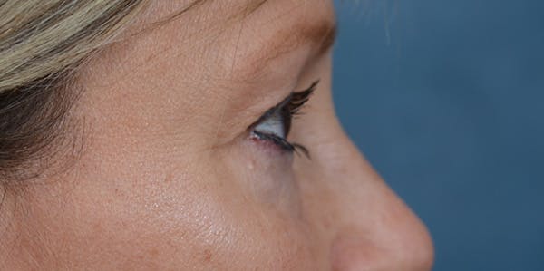 Eyelid Lift Before & After Gallery - Patient 29409181 - Image 9