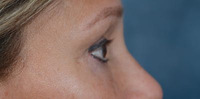 Eyelid Lift Before & After Gallery - Patient 29409181 - Image 10