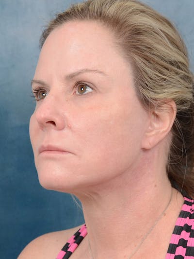 Deep Plane Facelift Before & After Gallery - Patient 40113234 - Image 2