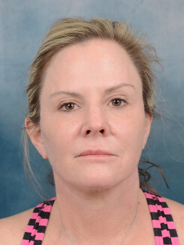 Deep Plane Facelift Before & After Gallery - Patient 40113234 - Image 4