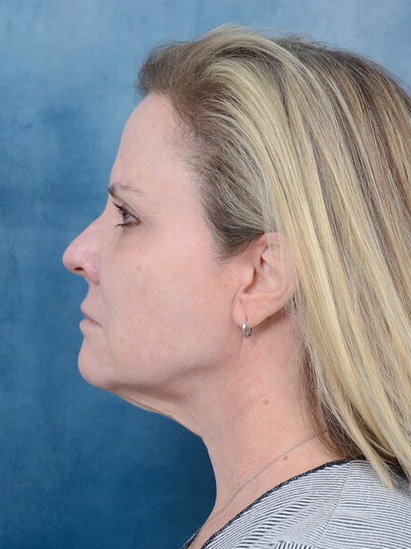 Deep Plane Facelift Before & After Gallery - Patient 40113234 - Image 5