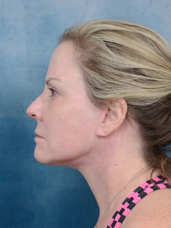 Deep Plane Facelift Before & After Gallery - Patient 40113234 - Image 6