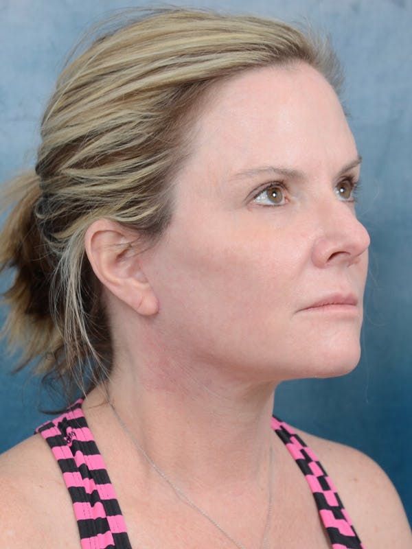 Deep Plane Facelift Before & After Gallery - Patient 40113234 - Image 8