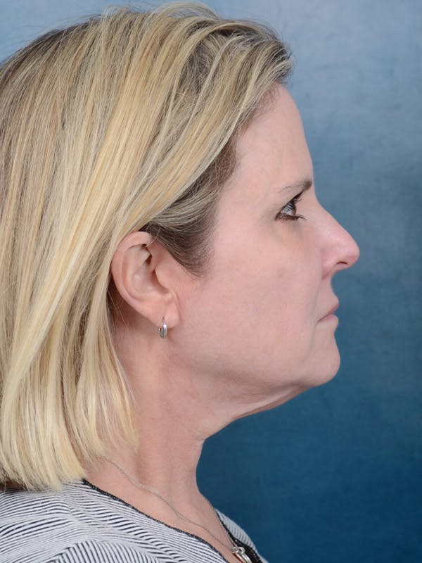 Deep Plane Facelift Before & After Gallery - Patient 40113234 - Image 9