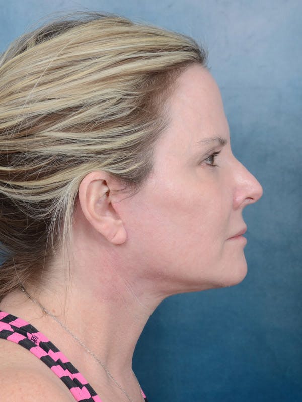 Deep Plane Facelift Before & After Gallery - Patient 40113234 - Image 10