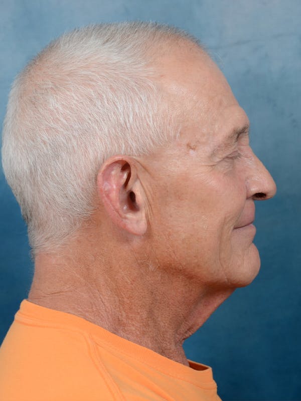 Deep Plane Facelift Before & After Gallery - Patient 40871140 - Image 5