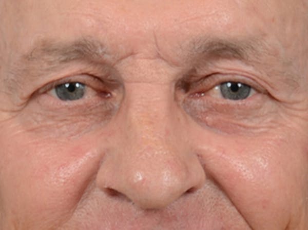 Eyelid Lift Before & After Gallery - Patient 40871211 - Image 1