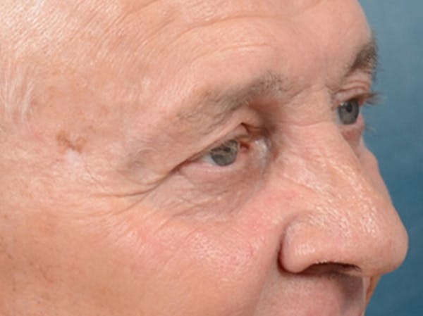 Eyelid Lift Before & After Gallery - Patient 40871211 - Image 3