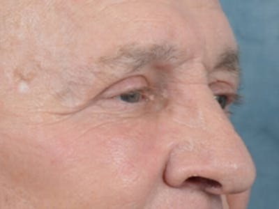 Eyelid Lift Before & After Gallery - Patient 40871211 - Image 4