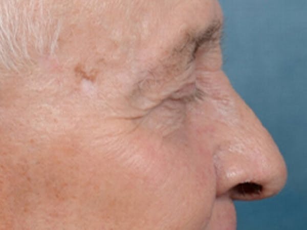 Eyelid Lift Before & After Gallery - Patient 40871211 - Image 5