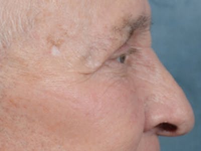 Eyelid Lift Before & After Gallery - Patient 40871211 - Image 6