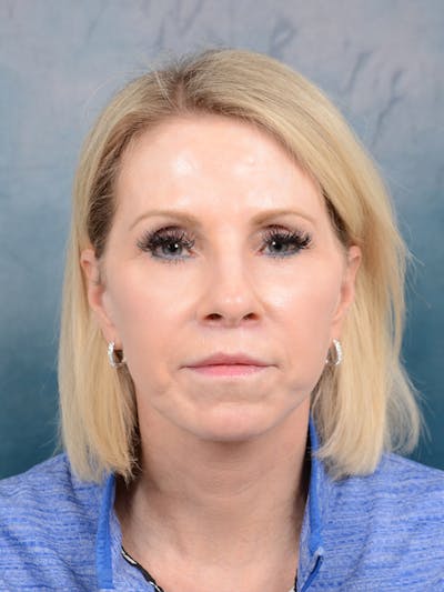 Deep Plane Facelift Before & After Gallery - Patient 41510459 - Image 4