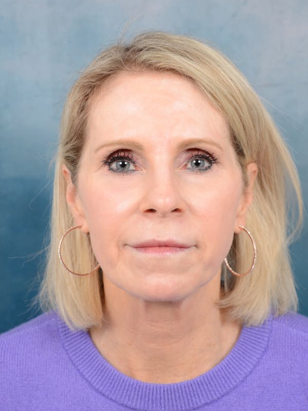 Deep Plane Facelift Before & After Gallery - Patient 41510459 - Image 3